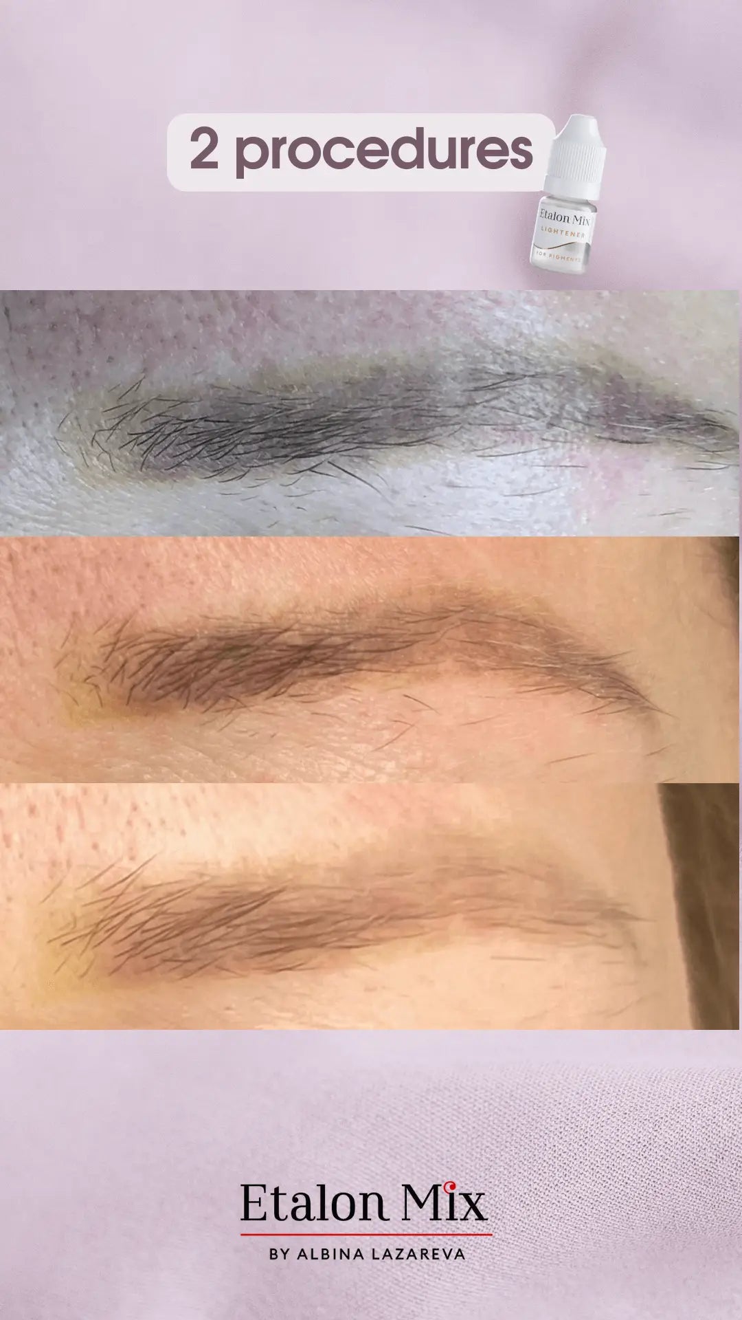 Etalonmix remover 5 ml